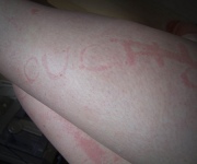 Acute Urticaria: Short Term Itch?